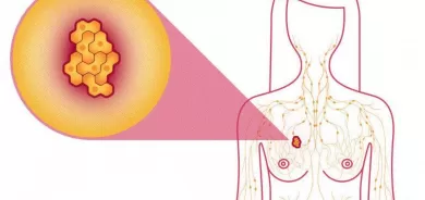 نظام التغذية الخاطئ تؤدي الى سرطان الثدي