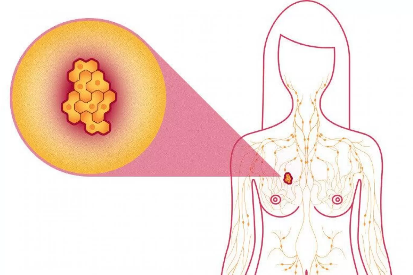 نظام التغذية الخاطئ تؤدي الى سرطان الثدي