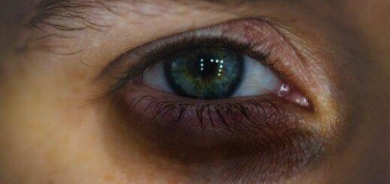 8 علاجات طبيعية للهالات السوداء حول العين