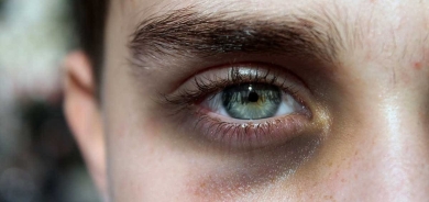 هالات أسفل العين قد تشير لأمراض خطيرة