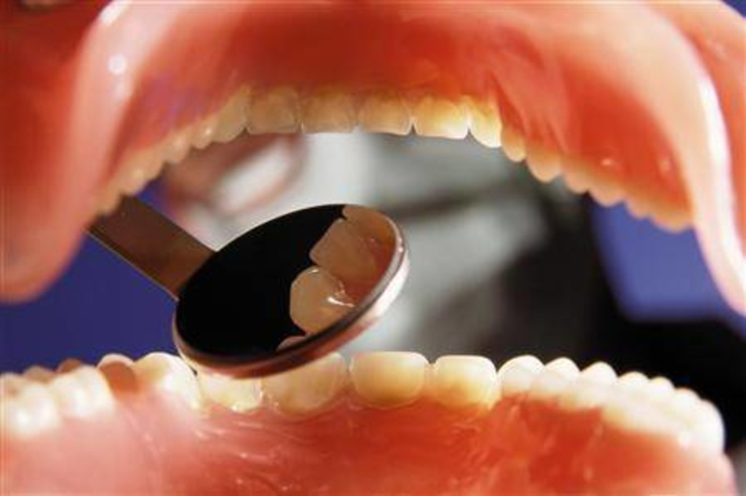 اكتشاف روابط جديدة بين صحة الأسنان والتدهور المعرفي