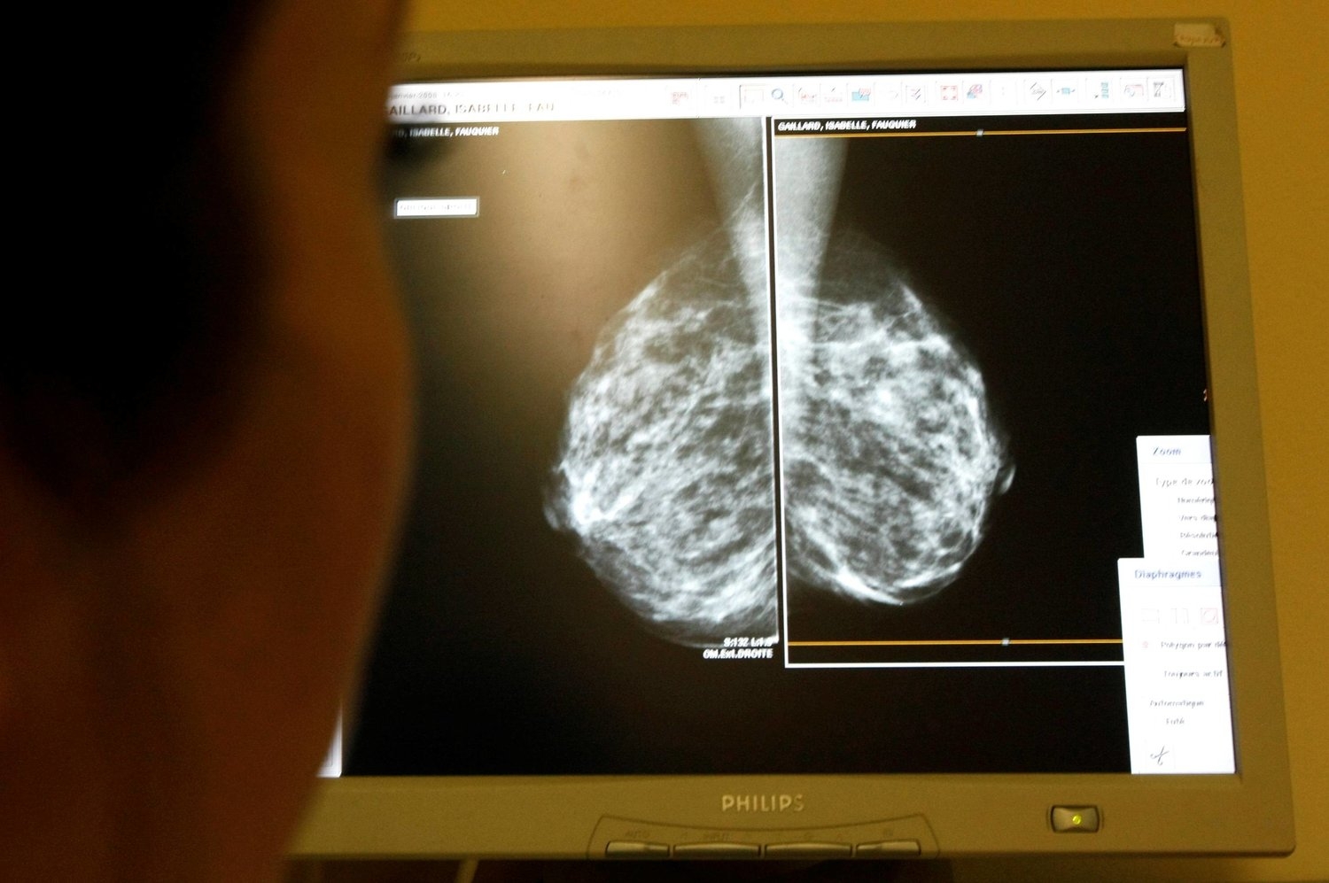 عقار تجريبي جديد يضعف سرطان الثدي العدواني