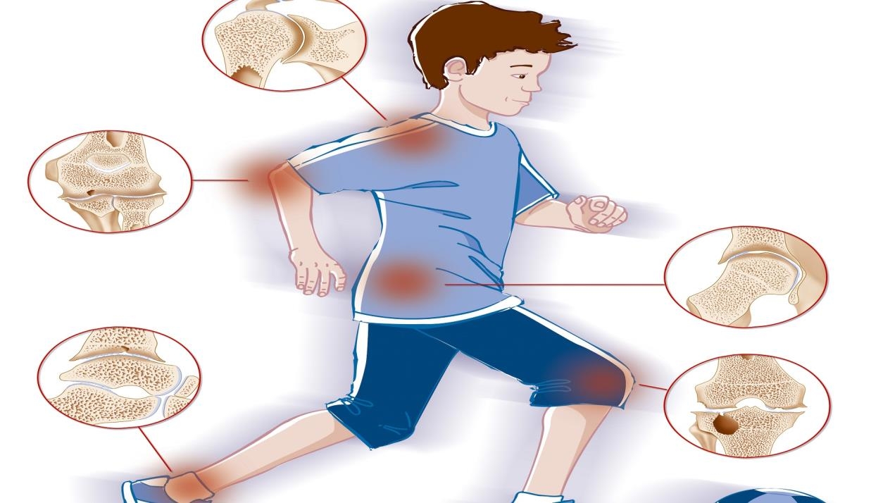4 أعراض تشير لالتهاب مفاصل الأطفال يجب الانتباه إليها