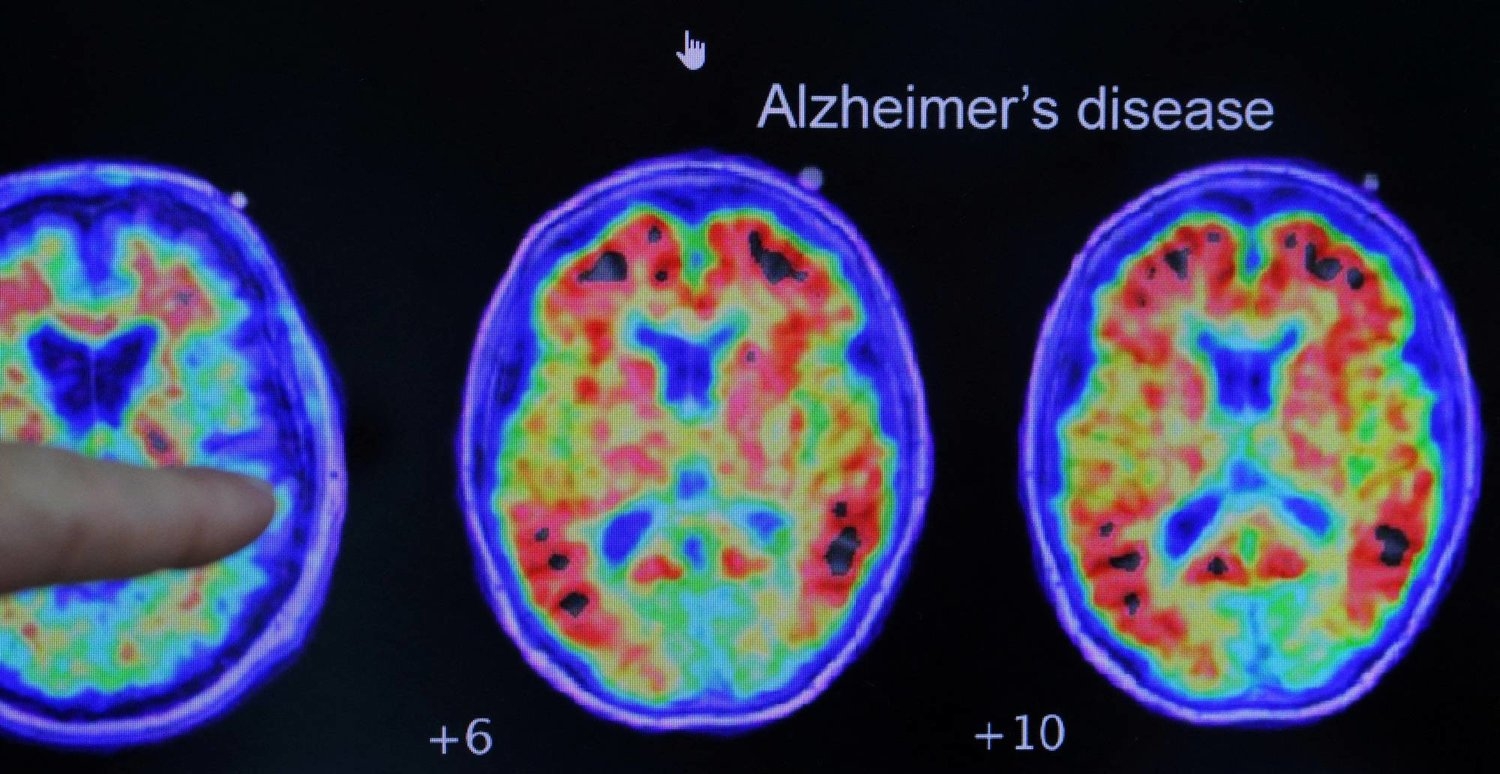 تفكيك اللغز... علماء يكتشفون كيف تموت خلايا الدماغ لدى مرضى ألزهايمر