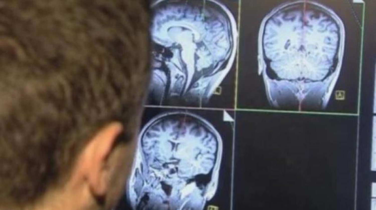 السكتة الدماغية... قد تسبب 10 ملايين حالة وفاة سنوياً بحلول عام 2050