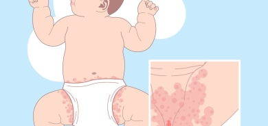 الالتهابات الفطرية للجلد لدى الأطفال