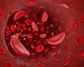 فقر الدم المنجلي... علاج جيني واعد وأبحاث على أدوية مطورة