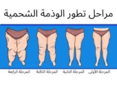 أعراضها تشبه السمنة... ما هي الوذمة الشحمية التي تصيب النساء؟