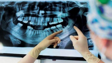 مرض ألزهايمر قد يكون مصدره الفم