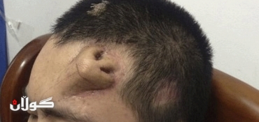 Chinese man has new nose grown on forehead