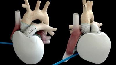French artificial heart patient home and 'leading normal life'