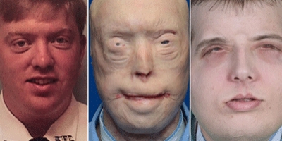 US firefighter's face transplant declared a success