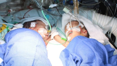 'Youngest' conjoined twins separated at Swiss hospital in Bern