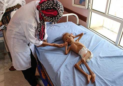 Five million children risk famine in war-torn Yemen