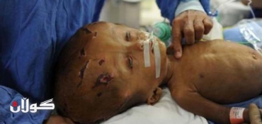 Indian medics reconstruct baby's swollen head