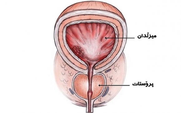 زۆربەی پیاوان دوچاری ئاوسانی پرۆستات دەبن